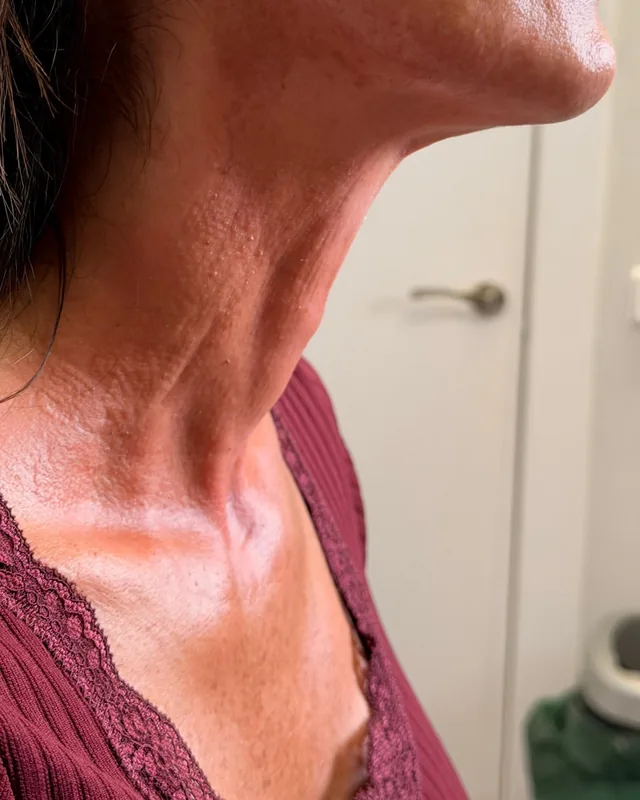 Cuello con flacidez y piel menos firme