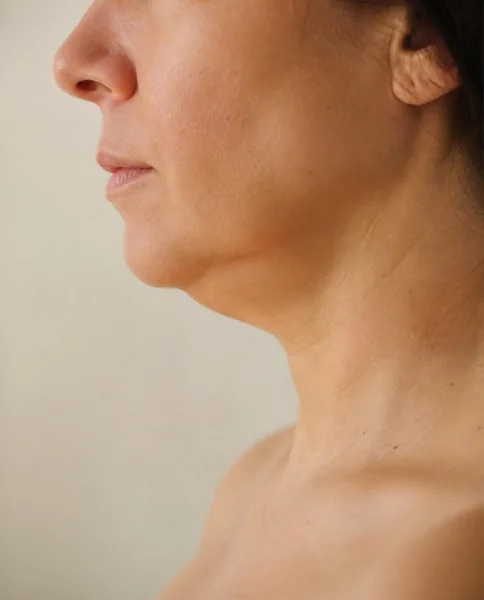Perfil con papada y ángulo del cuello poco definido